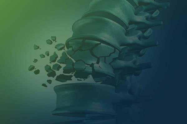 كسور العمود الفقري