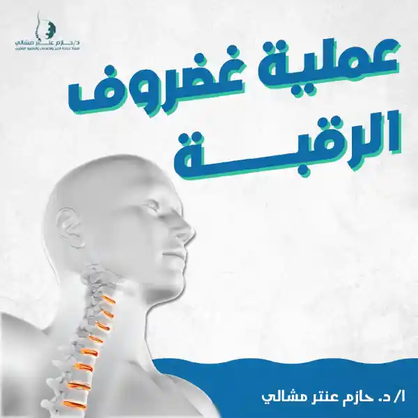 نسبة نجاح عملية غضروف الرقبة نسبة نجاح عملية غضروف الرقبة
