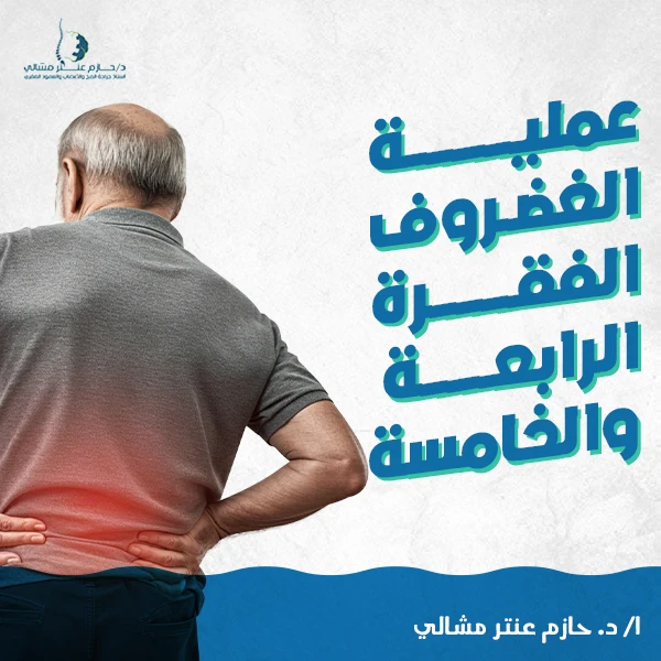 عملية الغضروف القطني​ الفقرة الرابعة والخامسة​