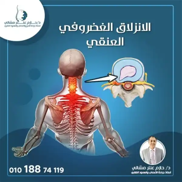 ما هي مضاعفات الجراحة للانزلاق الغضروفي العنقي