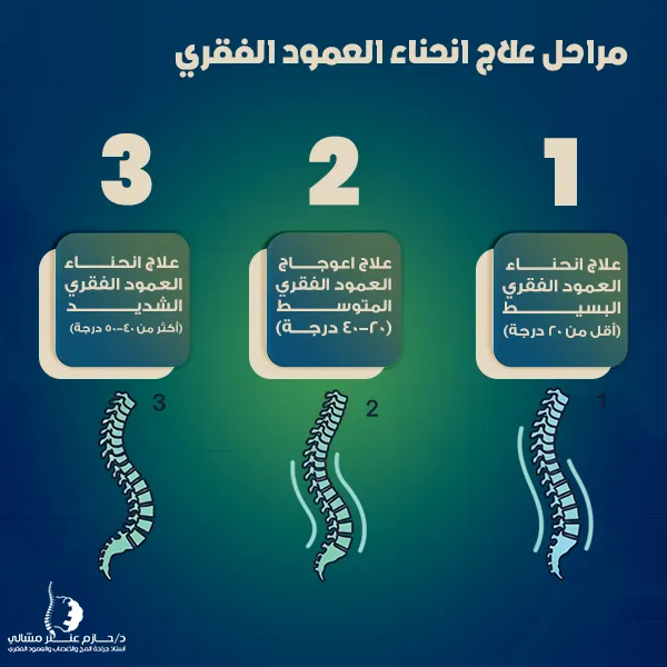 مراحل علاج انحناء العمود الفقري