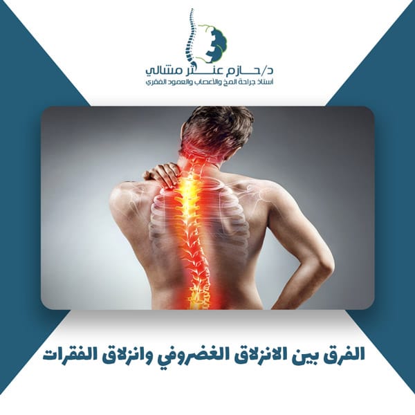 الفرق بين الانزلاق الغضروفي وانزلاق الفقرات