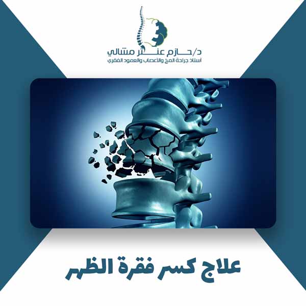 علاج كسر فقرة الظهر