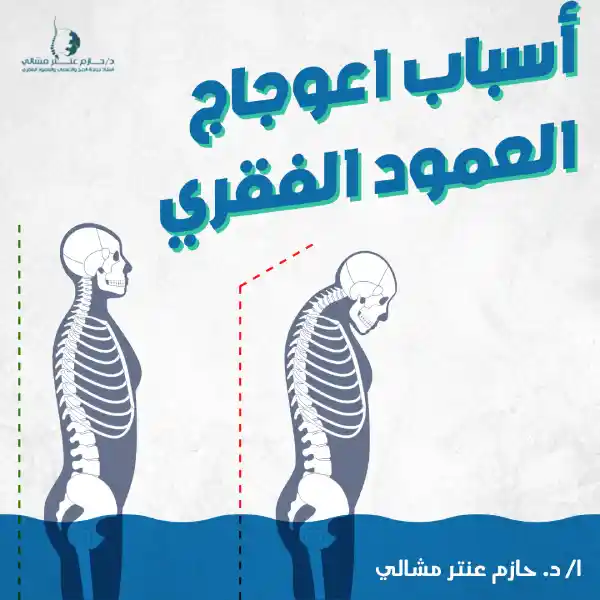أسباب اعوجاج العمود الفقري