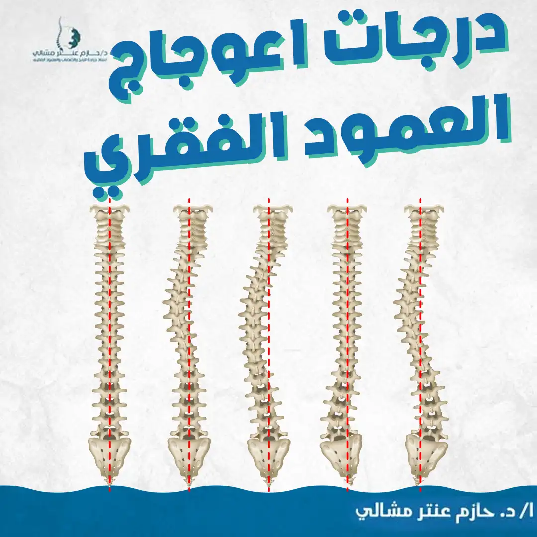 درجات اعوجاج العمود الفقري
